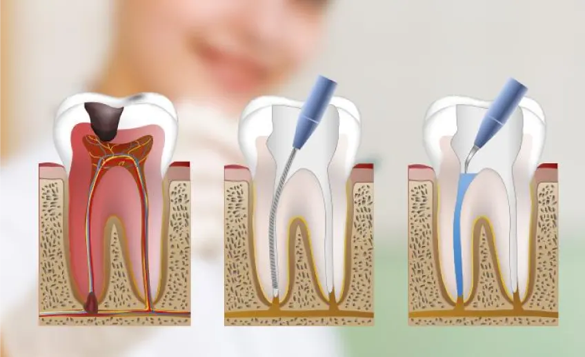 Endodoncia en Usera